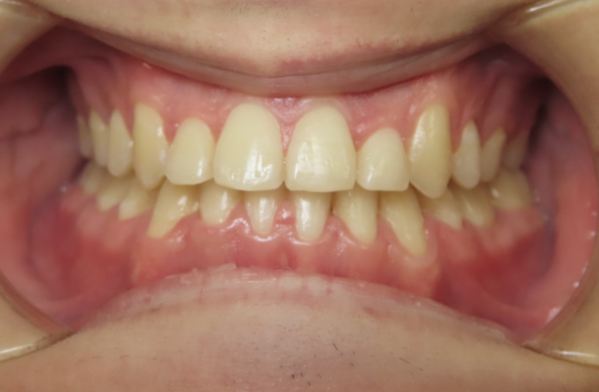 Before & After Archive - Hero Pediatric Dentistry