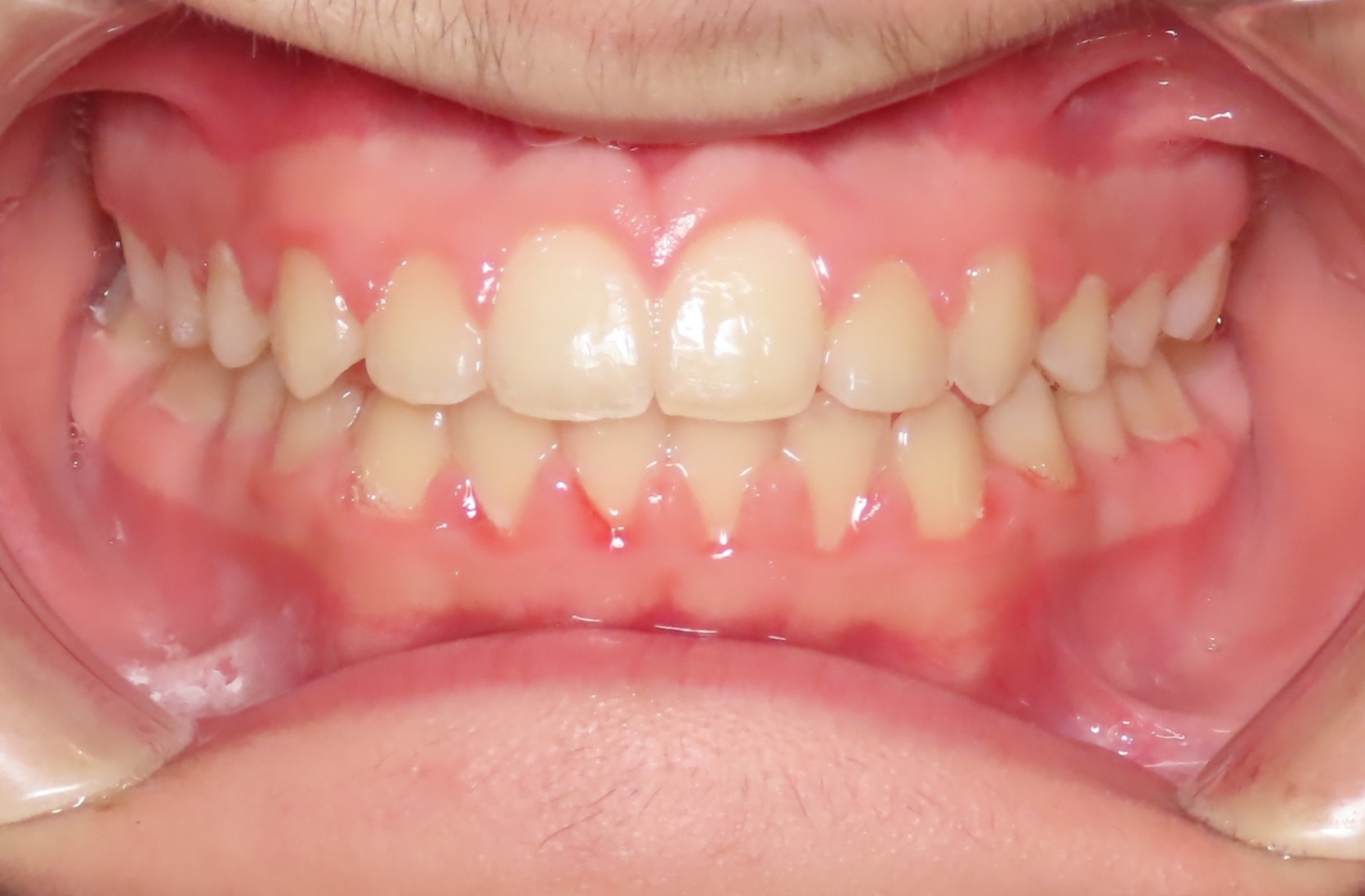 Before & After Archive - Hero Pediatric Dentistry