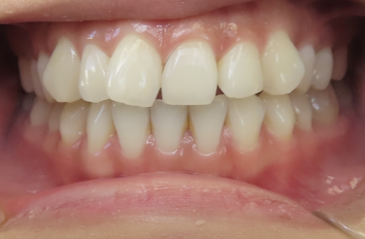 Inbrace Instruments Before & After Archive - Hero Pediatric Dentistry