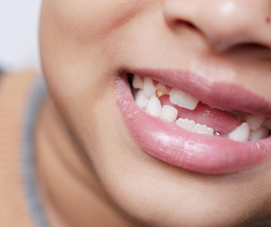 Hero Pediatric Dentistry - Pediatric Dental Crowns Herndon VA