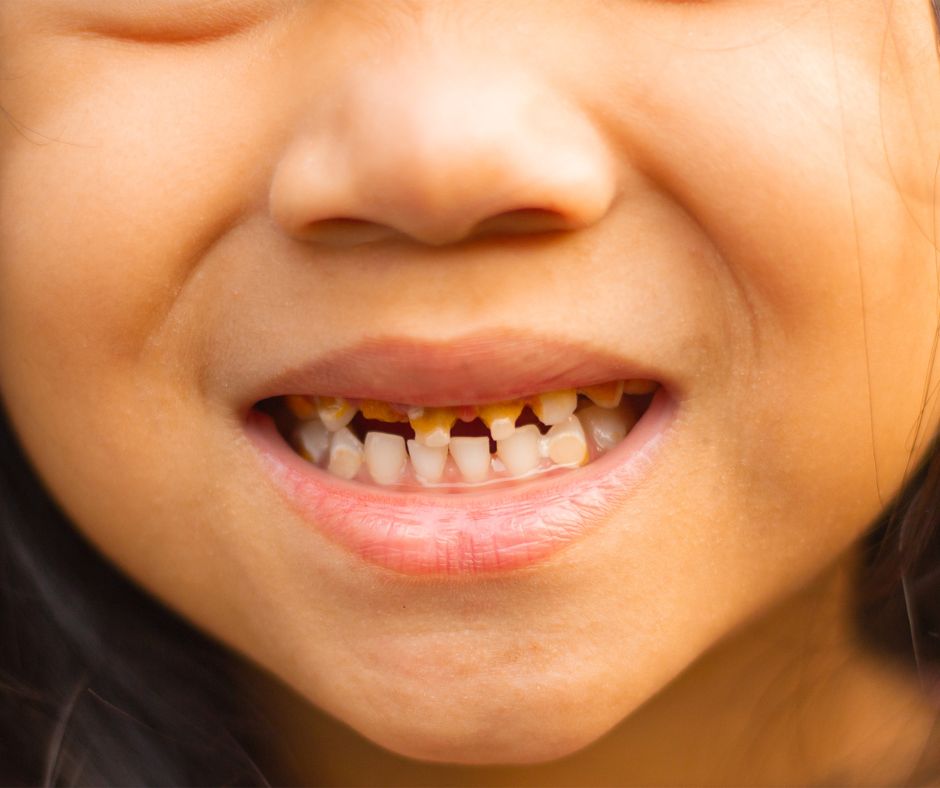 Hero Pediatric Dentistry - Understanding Stages of Tooth Decay