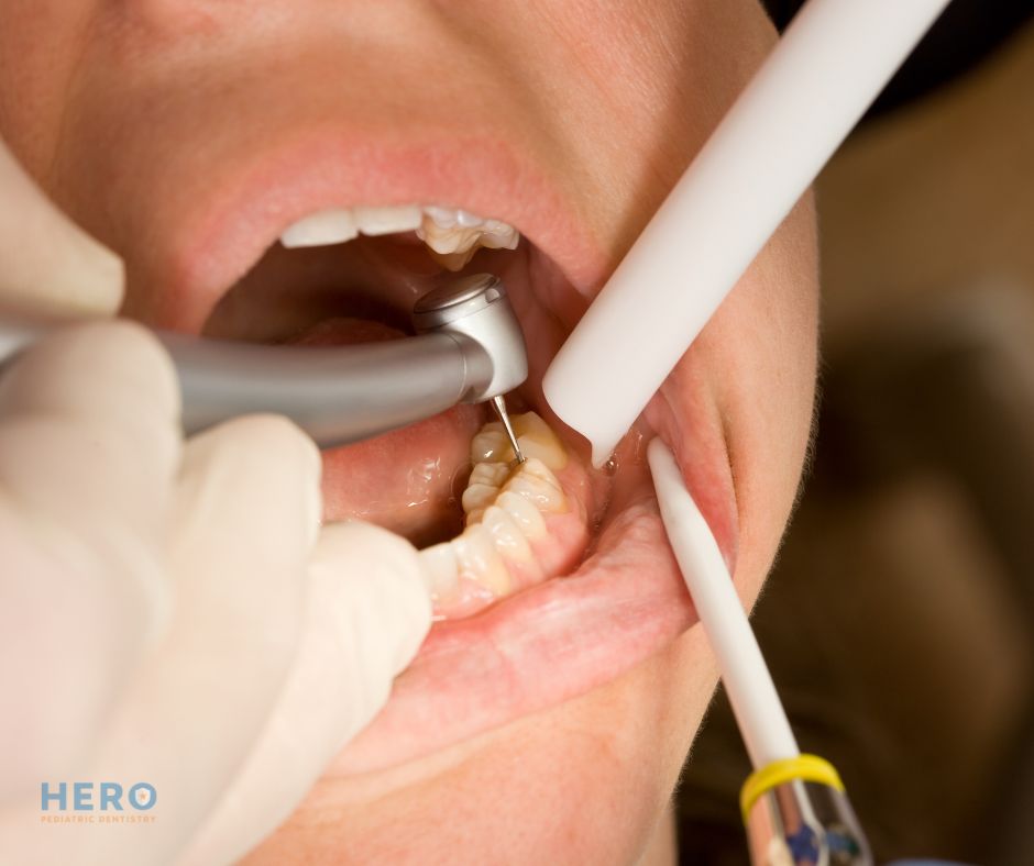 Hero Pediatric Dentistry - Cavity Filling in Fairfax, VA