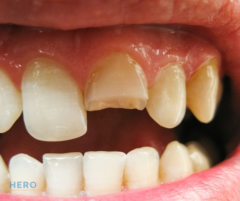 Hero Pediatric Dentistry - chipped tooth repair in Gainesville VA