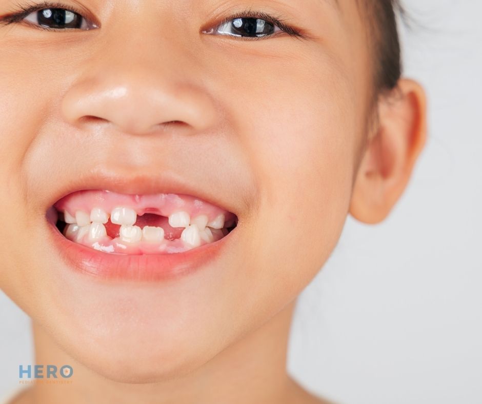 Hero Pediatric Dentistry - space maintainers in Northern Virginia