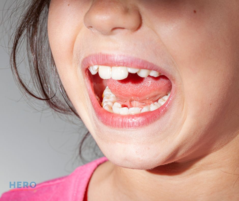 Hero Pediatric Dentistry - crossbite treatment near me Herndon VA